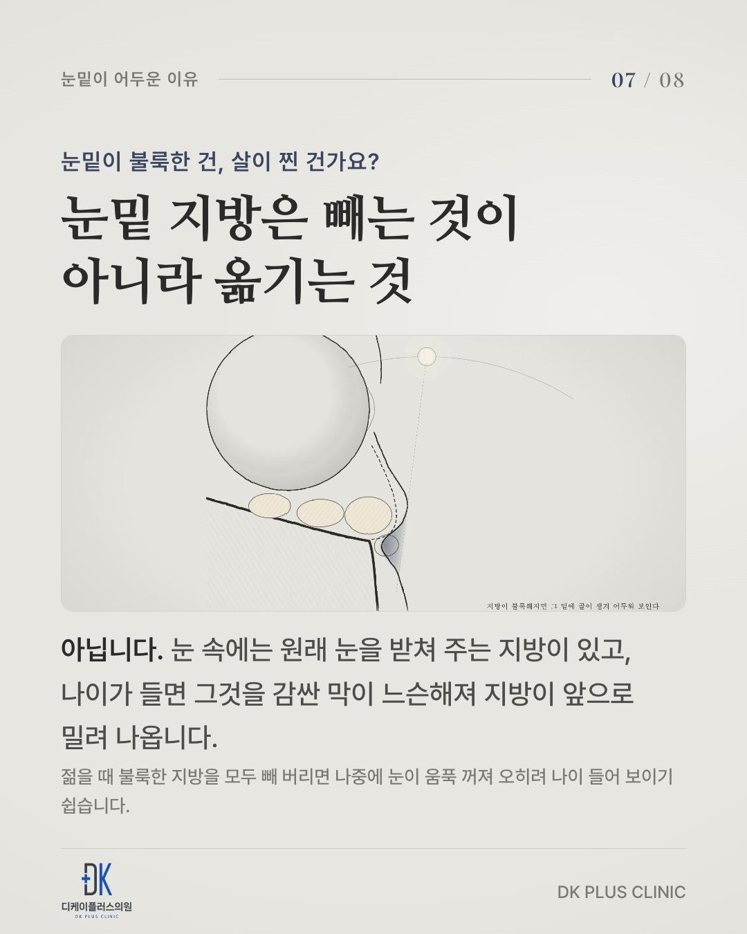 눈을 받쳐 주는 지방을 감싼 막이 느슨해지면 지방이 앞으로 밀려 나온다