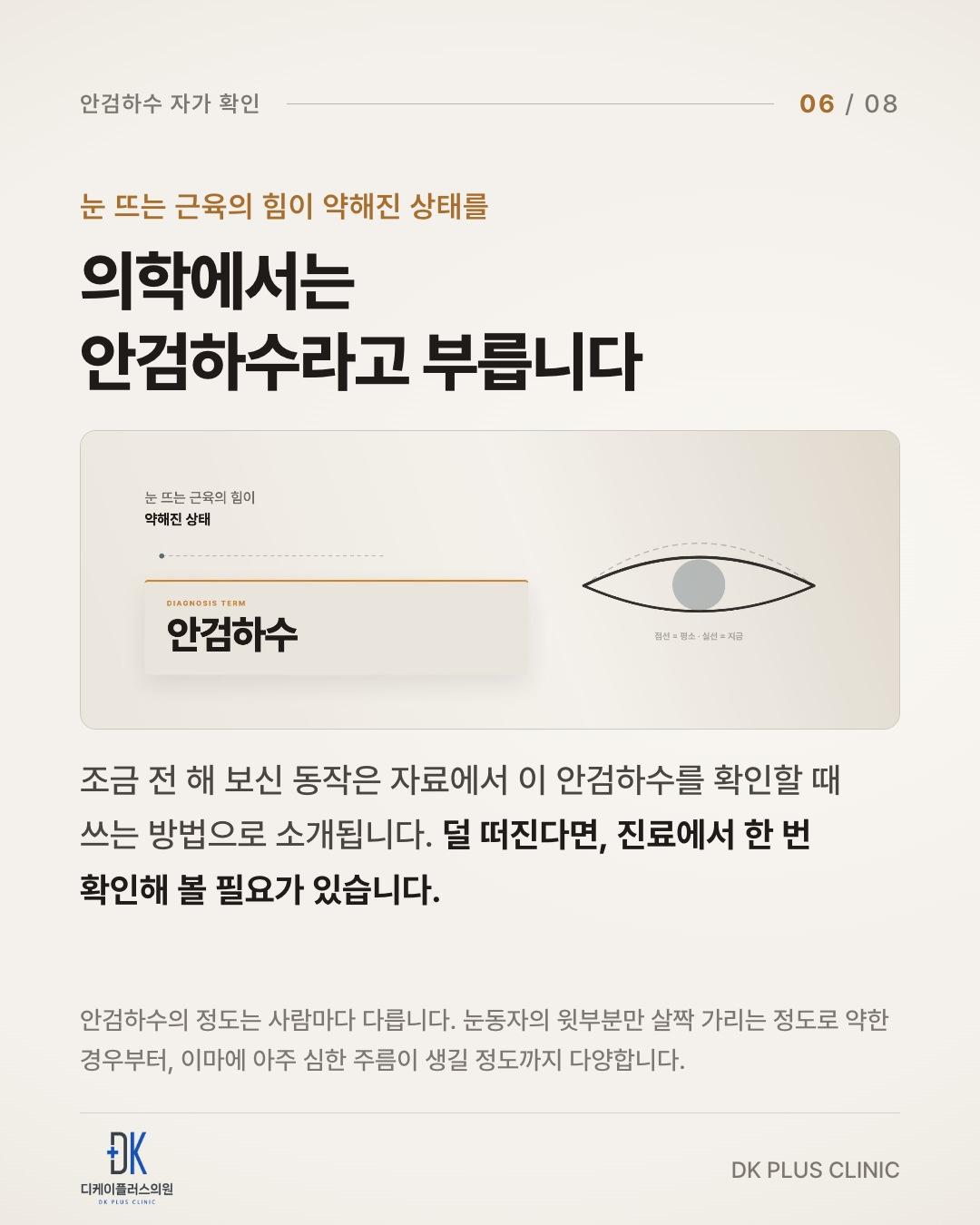 눈 뜨는 근육의 힘이 약해진 상태 — 안검하수