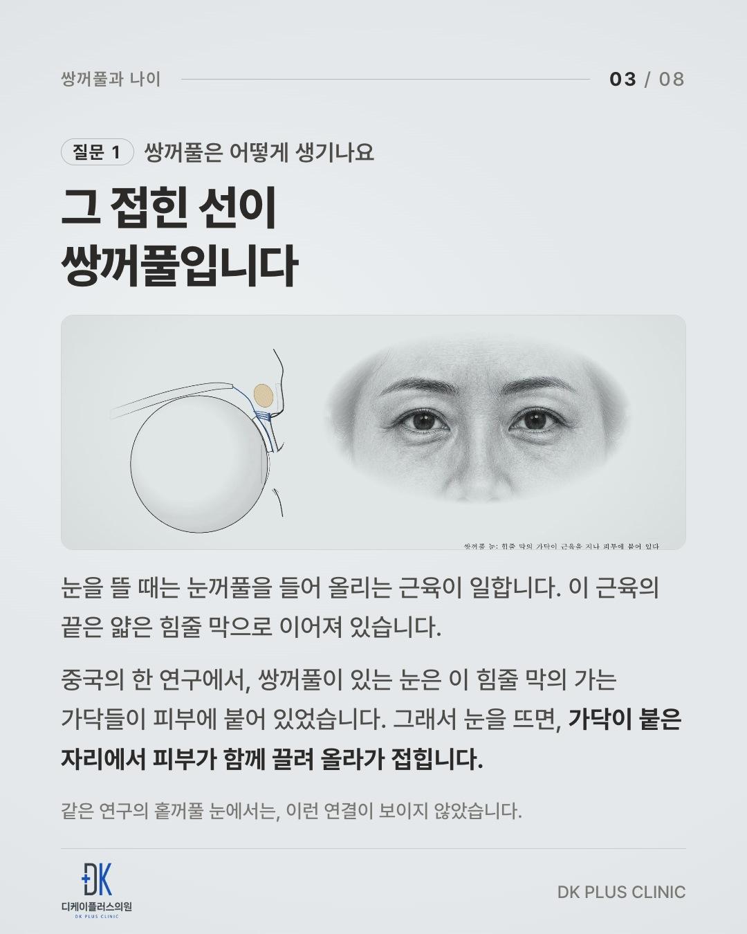 눈을 뜨면 가닥이 붙은 자리에서 피부가 함께 끌려 올라가 접힌다