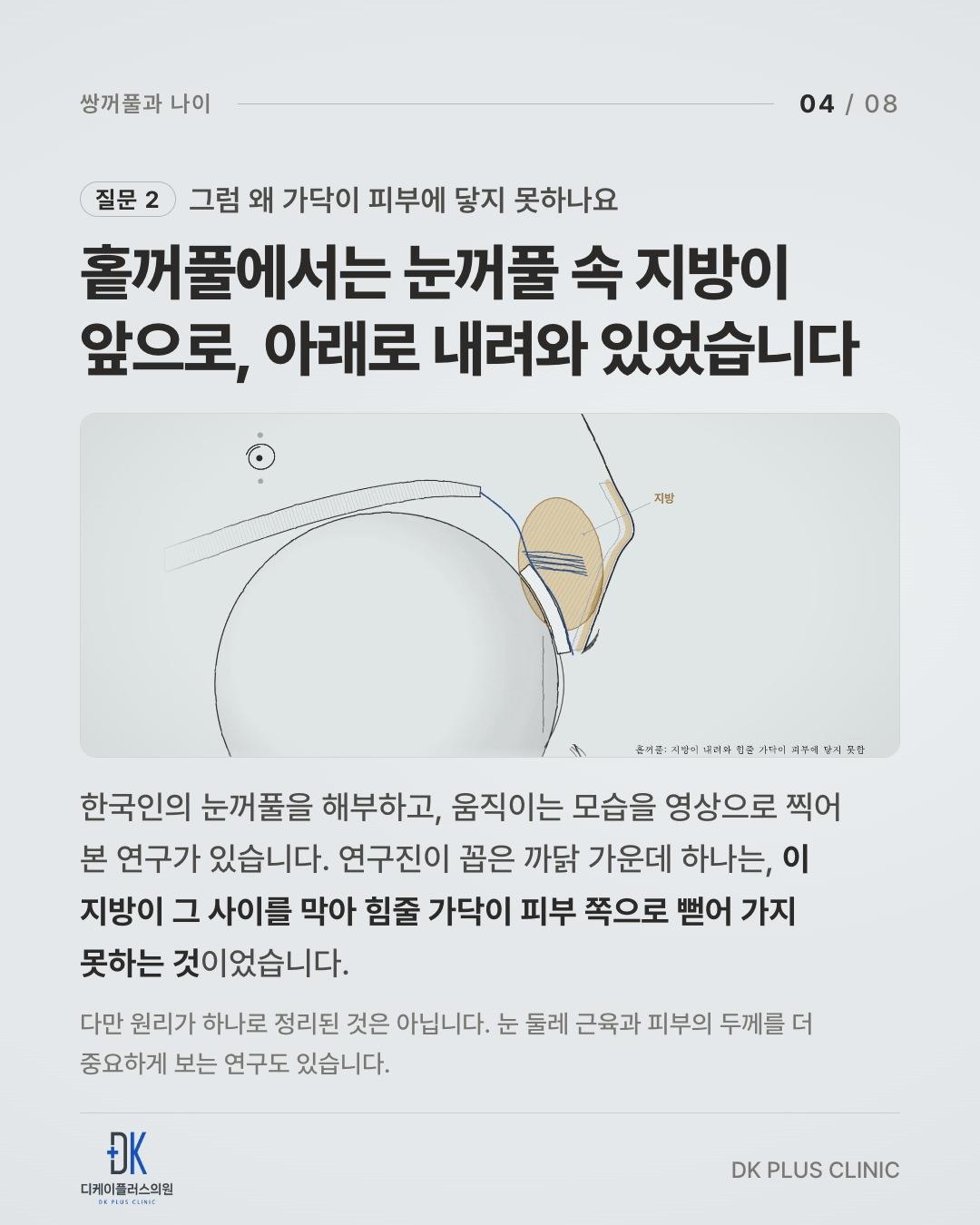 홑꺼풀 — 눈꺼풀 속 지방이 앞으로, 아래로 내려와 있다
