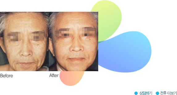 안면거상 전후 비교 사진 3