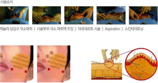 아큐스컬프 앞광대 부위 시술 사진