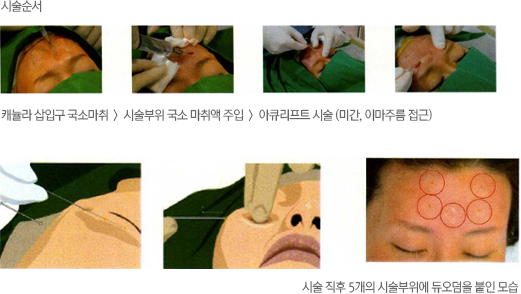 아큐스컬프 미간과 이마 부위 시술 사진