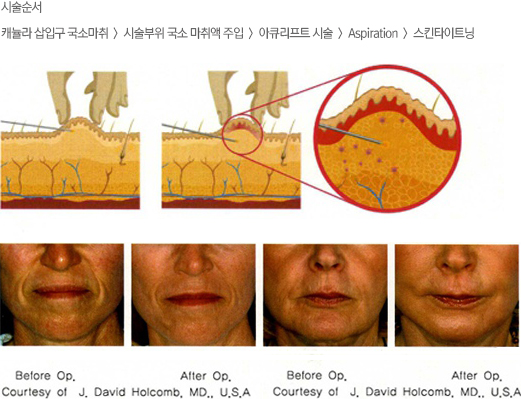 아큐스컬프 입가주름 부위 시술과 전후 사진