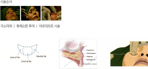아큐스컬프 눈밑 부위 시술 사진