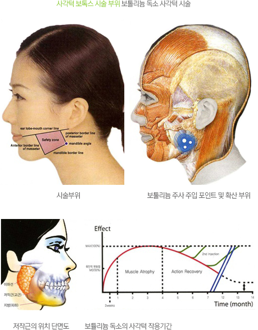 사각턱 보톡스 시술 부위와 근육 해부도
