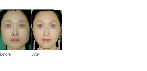 사각턱 축소술 전후 비교 사진(정면)
