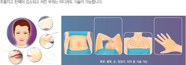 얼굴과 신체에서 시술 가능한 부위를 표시한 도해