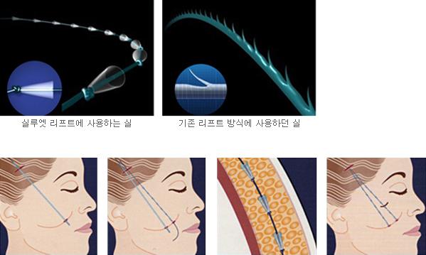 실루엣 리프트와 기존 리프트 방식에 사용하는 실을 비교한 도해