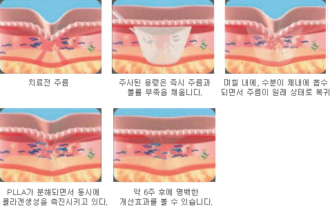스컬트라 주사 후 피부 변화 5단계 진행 도해