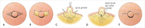유관을 보존하는 함몰유두 교정 단계도