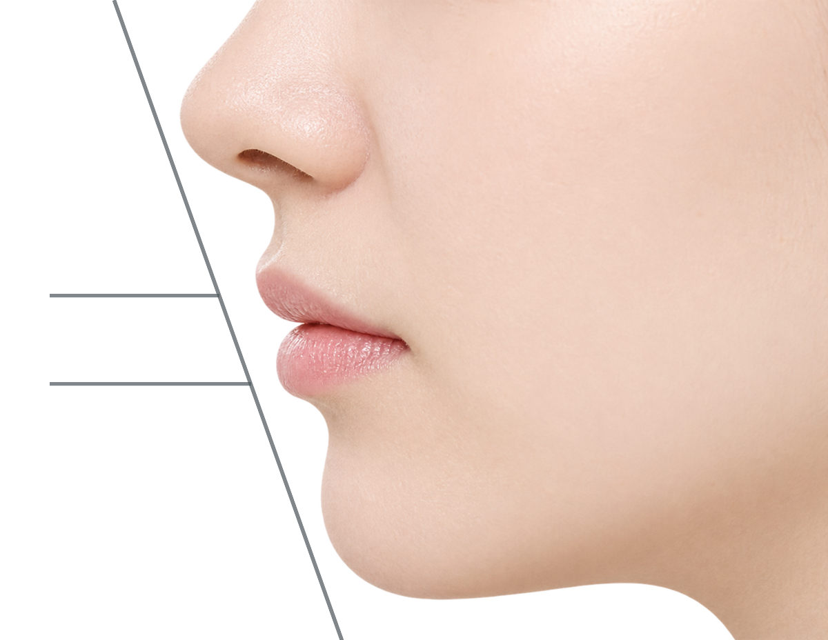 무턱 형태를 4mm·2mm 측정선으로 표시한 옆모습 입·턱 근접 사진